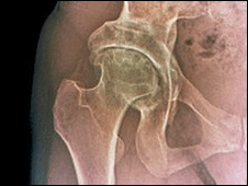 Suplementos para la artritis "no funcionan"