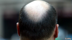 ¿Por qué los calvos pierden primero el pelo de la coronilla?