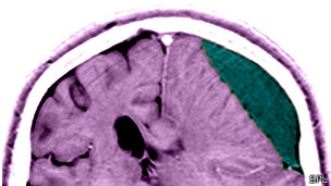 Un golpe en el cerebro puede dejar secuelas de por vida