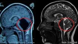 La joven china que probó que se puede vivir sin cerebelo