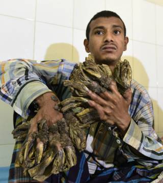 La extraña enfermedad del "hombre-árbol" de Bangladesh