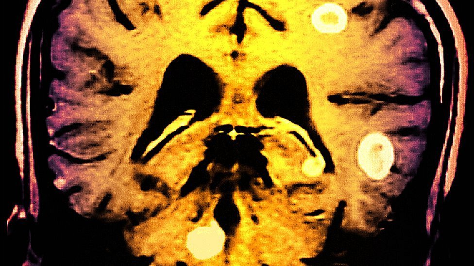 Tuberculosis en el cerebro: "El dolor es tan fuerte que me dan ganas de cortarme la cabeza"