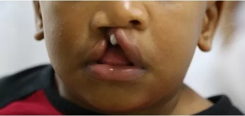 Anuncian jornada quirúrgica para niños con labios leporinos