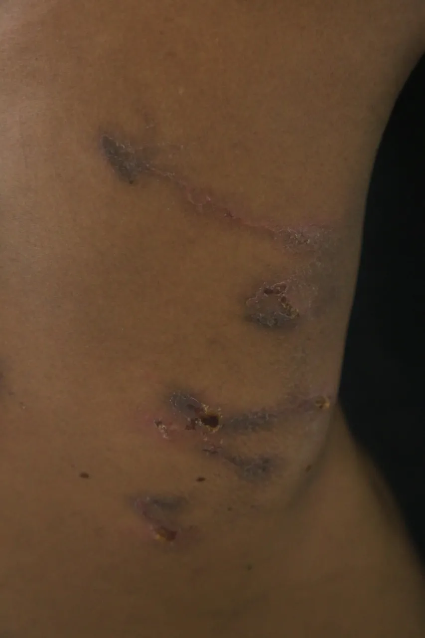 Haití reporta enfermedad 'altamente contagiosa' por contacto con la piel