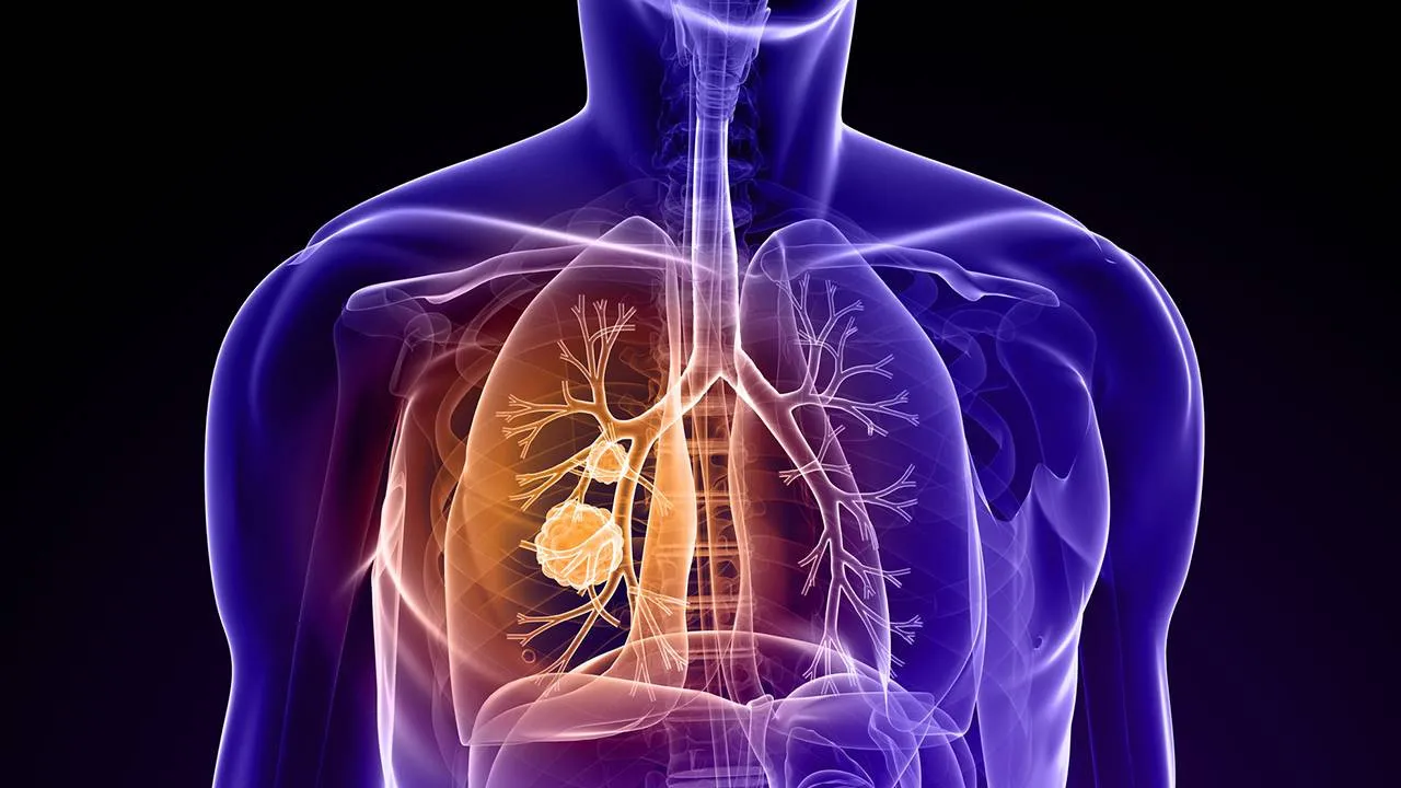 Un paso hacia más fármacos para el cáncer de pulmón, al desvelar una proteína