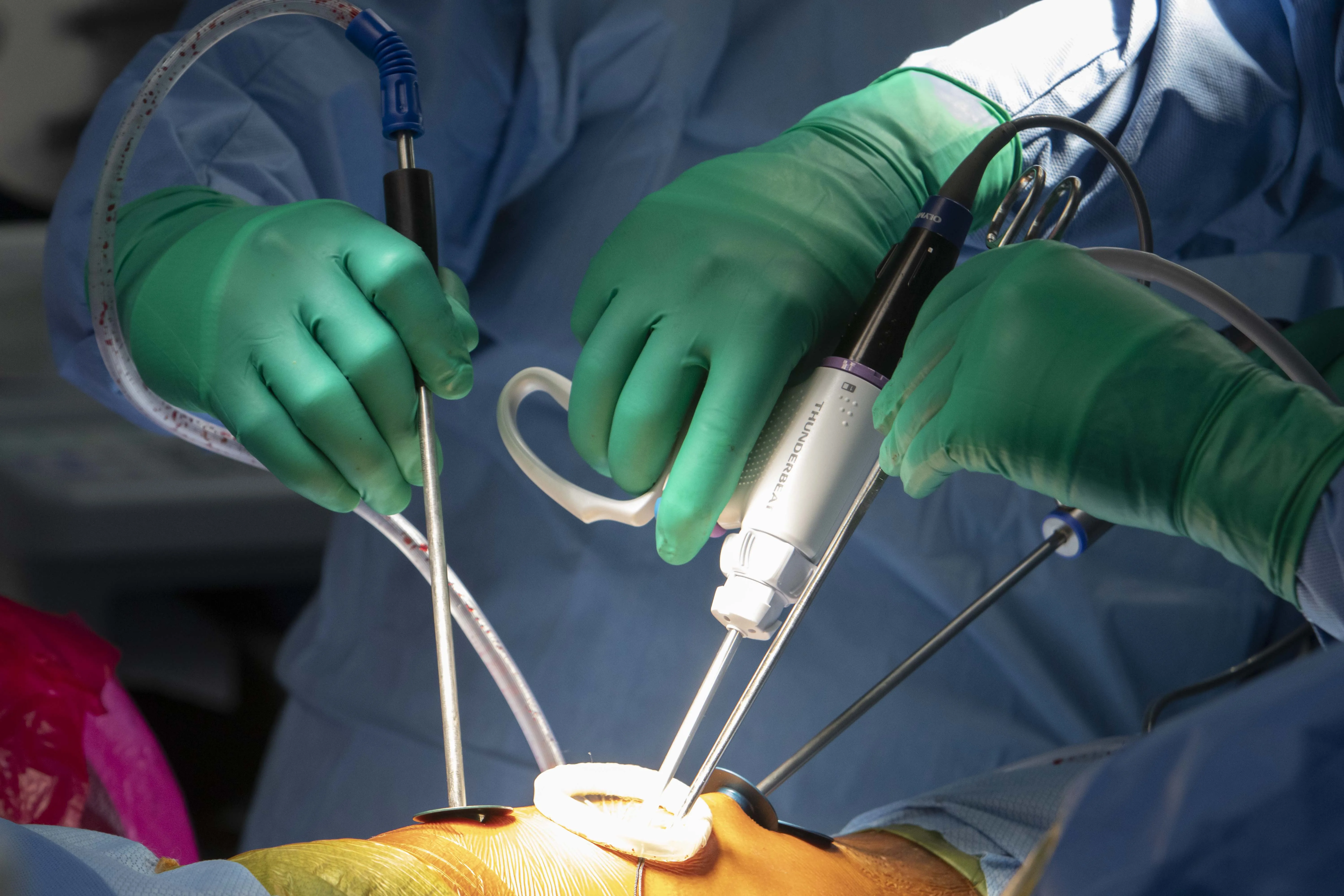 Cirugía de escoliosis sin abrir al paciente