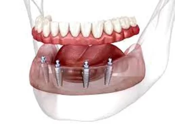 Sistema de implantes dentales TeethXpress: El valor inconmesurable de sonreir y comer