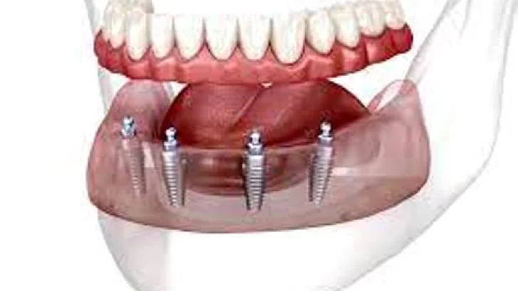 Sistema de implantes dentales TeethXpress: El valor inconmesurable de sonreir y comer