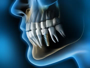 Implantes dentales: Opciones para dientes faltantes