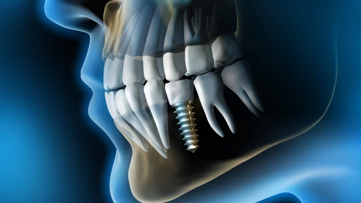 Implantes dentales: Opciones para dientes faltantes
