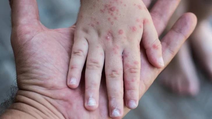 Alerta de sarampión en América: Cómo prevenir el contagio