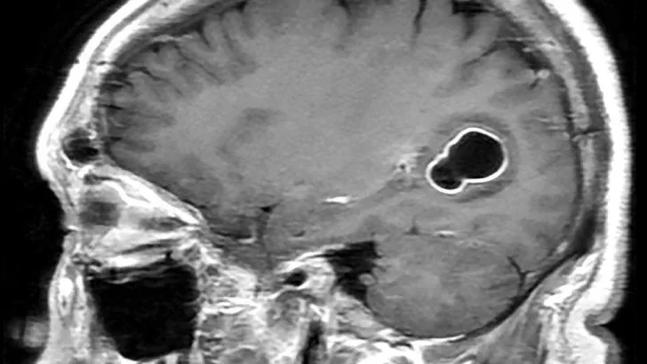 El hombre con migrañas al que médicos en EE.UU. le encontraron larvas en el cerebro por comer carne de cerdo poco cocida