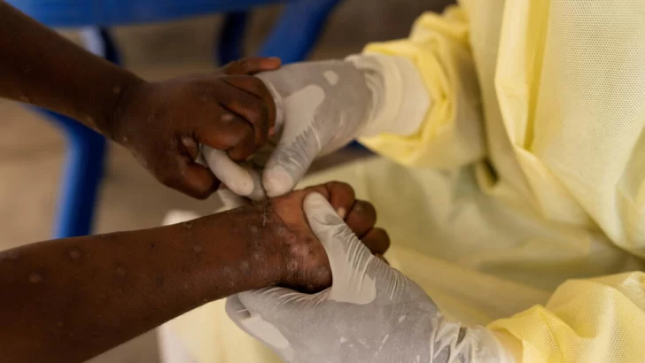 África se enfrenta a una emergencia sanitaria continental por el virus mpox