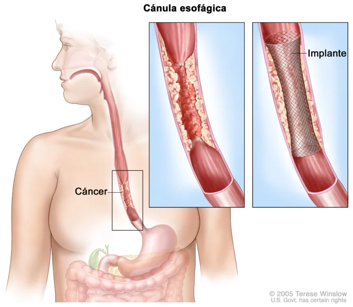 Cancer-de-Esofago-alerta-y-prevencion-en-la-lucha-contra-una-enfermedad-silenciosa-1-728x634