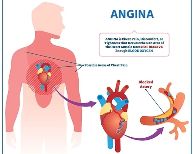 Calor provoca sobreesfuerzo al corazón que le obliga a trabajar tres veces más, según cardiólogo