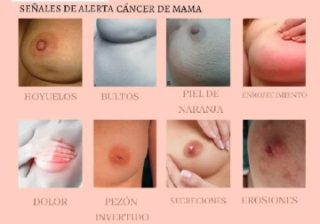 Alertan desproporcionado aumento de dominicanas con cáncer de mama Alertan desproporcionado aumento de dominicanas con cáncer de mama