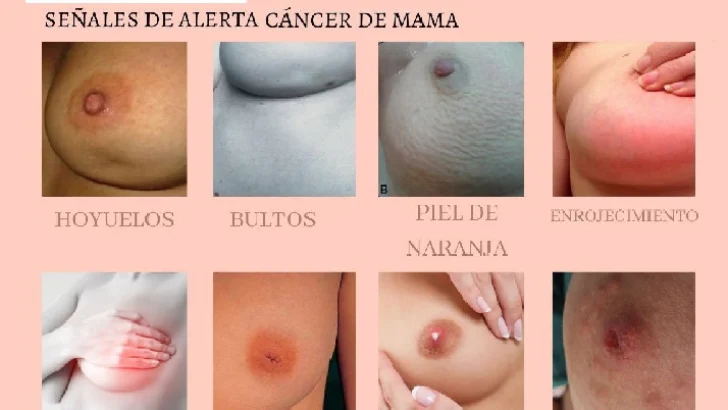 Alertan desproporcionado aumento de dominicanas con cáncer de mama