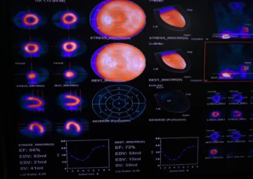 CEDIMAT realiza la primera gammagrafía cardíaca con Regadenoson CEDIMAT realiza la primera gammagrafía cardíaca con Regadenoson