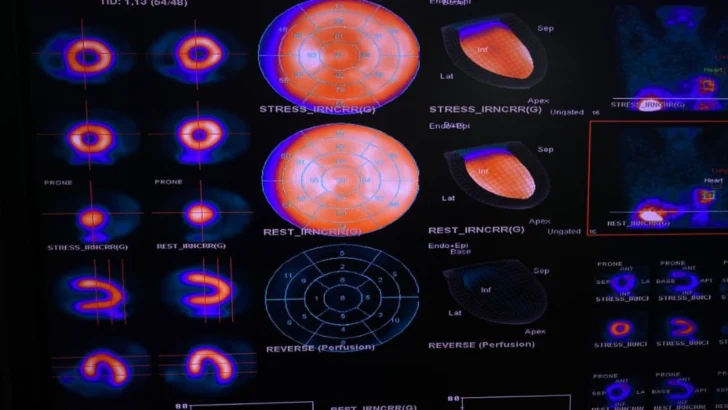 CEDIMAT realiza la primera gammagrafía cardíaca con Regadenoson CEDIMAT realiza la primera gammagrafía cardíaca con Regadenoson