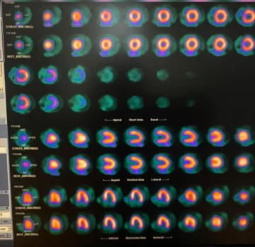 CEDIMAT realiza la primera gammagrafía cardíaca con Regadenoson