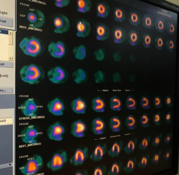 CEDIMAT realiza la primera gammagrafía cardíaca con Regadenoson
