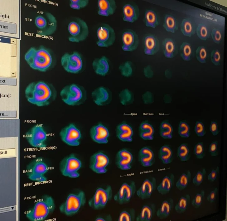 CEDIMAT realiza la primera gammagrafía cardíaca con Regadenoson