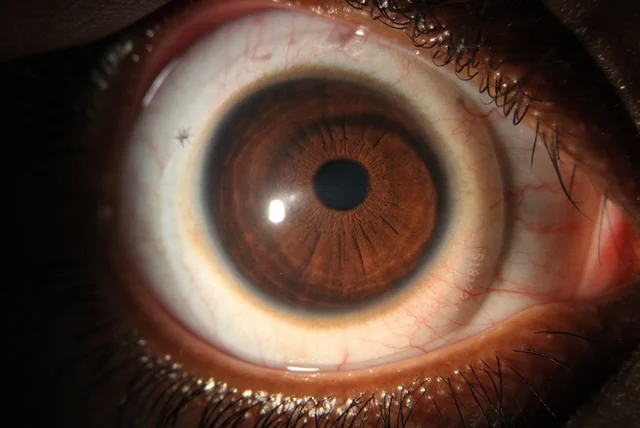 Oftalmóloga advierte 200 mil dominicanos podrían padecer queratocono sin saberlo