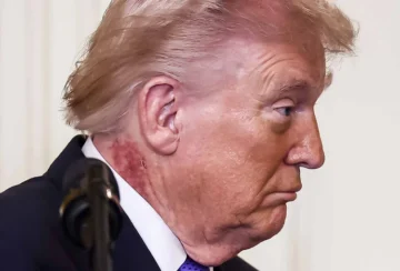 Trump luce un sarpullido en el cuello, que su médico atribuye a un tratamiento preventivo Trump luce un sarpullido en el cuello, que su médico atribuye a un tratamiento preventivo